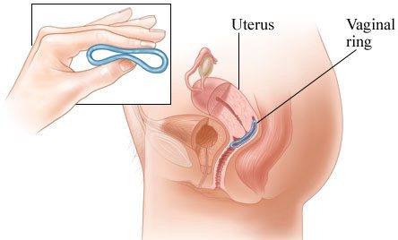 Operación del anillo Nuvaring para insertarlo en su vagina
