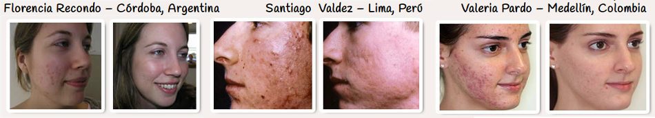Fotos anteriores y testimonios de clientes que han probado y aprobado Milagro para el acné